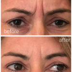 before and after image of frown lines reduction with botox
