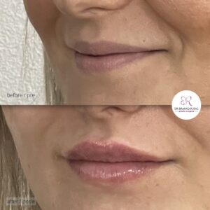 dr Branko Rudic - korekcija usana hijaluronom