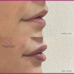 dr Branko Rudic - korekcija usana hijaluronom