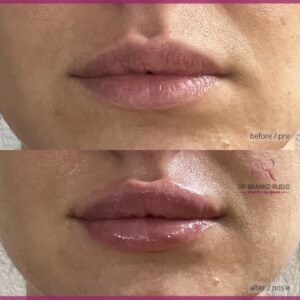 dr Branko Rudic - korekcija usana hijaluronom
