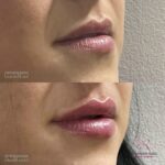 dr Branko Rudic - korekcija usana hijaluronom