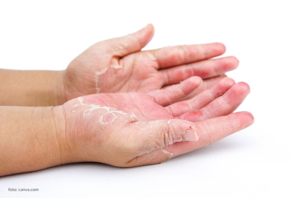 dry hands