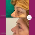 Blefaroplastika - dr Branko Rudic