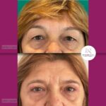 Blefaroplastika - dr Branko Rudic