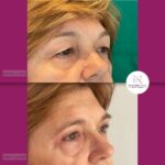 Blefaroplastika - dr Branko Rudic