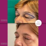 Blefaroplastika - dr Branko Rudic