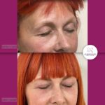 Blefaroplastika - dr Branko Rudic