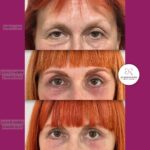 Blefaroplastika - dr Branko Rudic