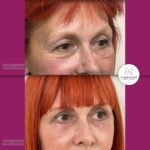 Blefaroplastika - dr Branko Rudic