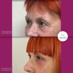 Blefaroplastika - dr Branko Rudic