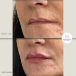 korekcija usana hijaluronom - dr Branko Rudic