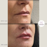 korekcija usana hijaluronom - dr Branko Rudic