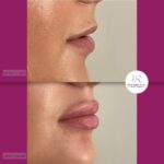 korekcija usana hijaluronom - dr Branko Rudic