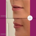 korekcija usana hijaluronom - dr Branko Rudic