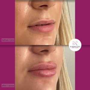 korekcija usana hijaluronom - dr Branko Rudic