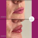 korekcija usana hijaluronom - dr Branko Rudic (1)