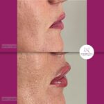 korekcija usana hijaluronom - dr Branko Rudic