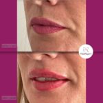 korekcija usana hijaluronom - dr Branko Rudic