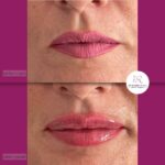 korekcija usana hijaluronom - dr Branko Rudic