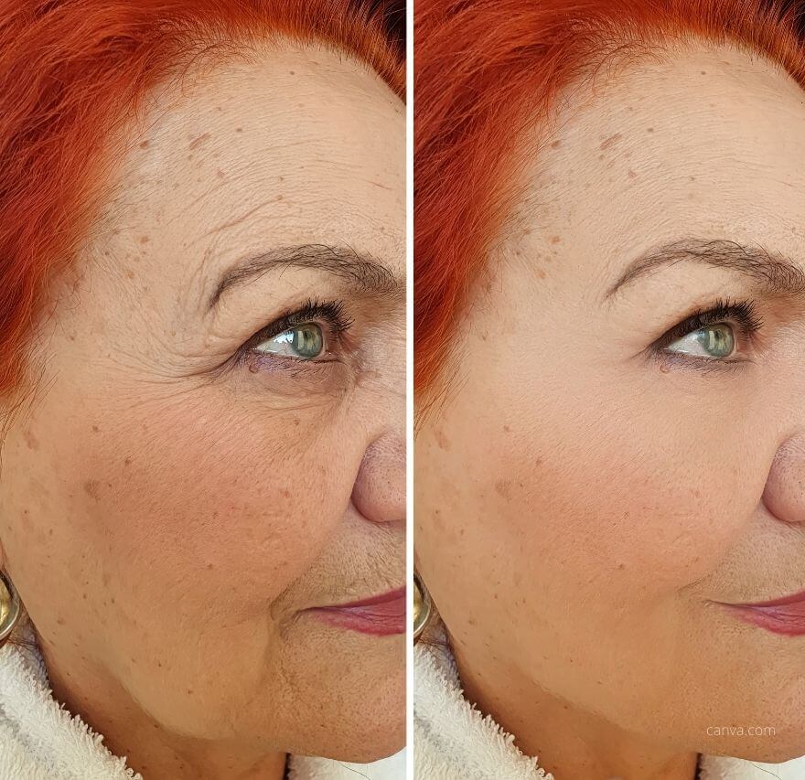 podmladjivanje lica - face lift